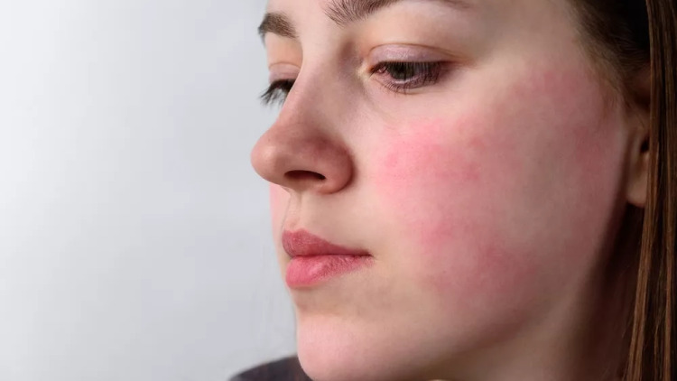 Δέρμα σε κατάσταση «συναγερμού» – Οι λύσεις που χαρίζουν ανακούφιση τον χειμώνα
