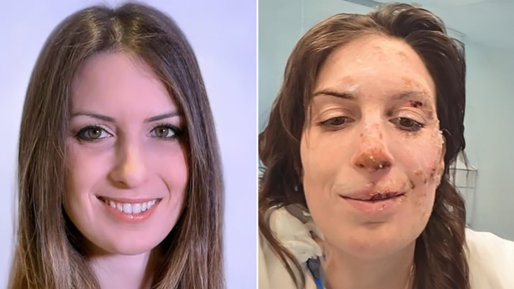 «Η ψυχή χρειάζεται περισσότερο χρόνο για να επουλωθεί»: Εξιτήριο για 29χρονη μετά τη φωτιά στο Κραν Μοντανά, ο μακρύς δρόμος της αποκατάστασης