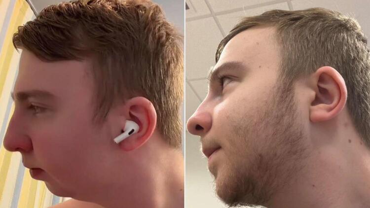 Ο άνθρωπος που υποβλήθηκε σε διπλή επέμβαση γνάθου: Η μεγάλη αλλαγή στην εμφάνισή του