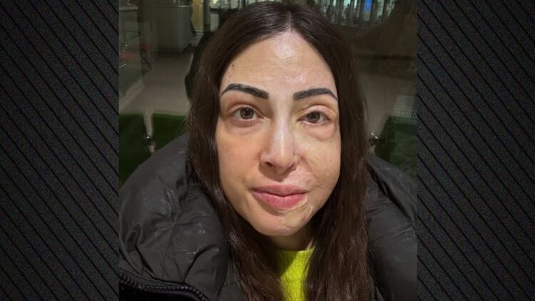 Η Ιωάννα Παλιοσπύρου ανέβασε εικόνες και βίντεο από την αποκατάσταση μετά την επίθεση με βιτριόλι