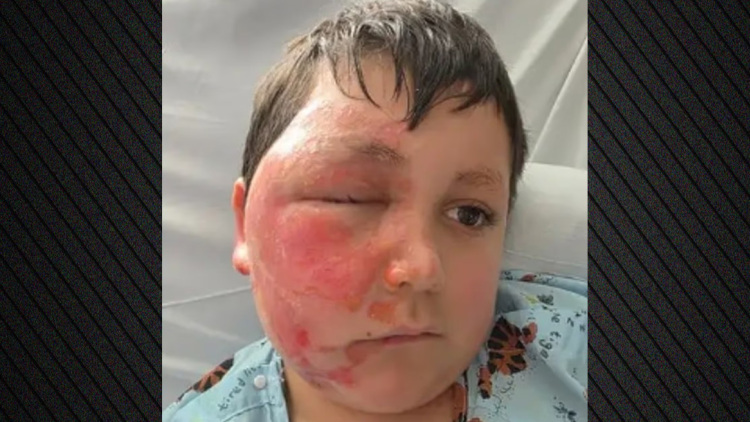 Σοβαρά εγκαύματα από φούρνο μικροκυμάτων υπέστη 9χρονος στο Ιλινόι για ένα trend στο Tik Tok: Δείτε βίντεο