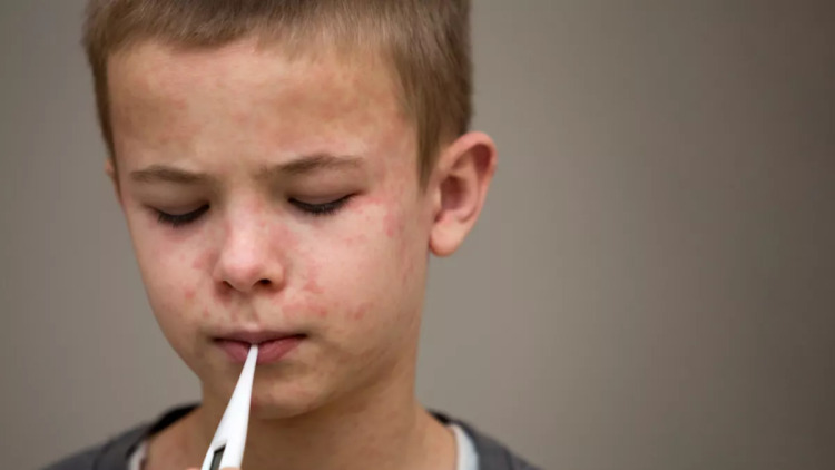 Η ιλαρά σε άνοδο στην Ευρώπη: 7.655 κρούσματα το 2025 – Ποιες χώρες «χτυπά» περισσότερο