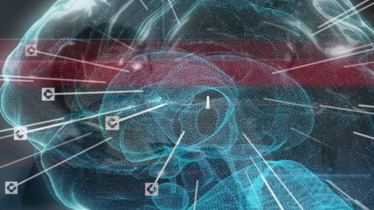 Στένωση καρωτίδων: Το «σιωπηλό» αίτιο του εγκεφαλικού επεισοδίου