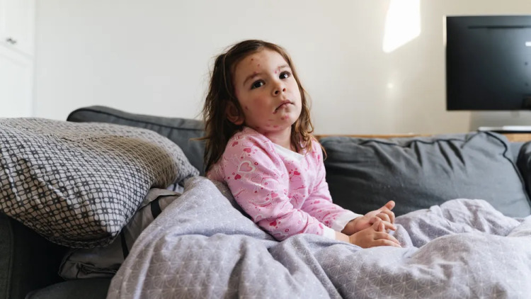 Ιλαρά: «Έκρηξη» κρουσμάτων ακόμη και με μικρή μείωση 1% στους εμβολιασμούς