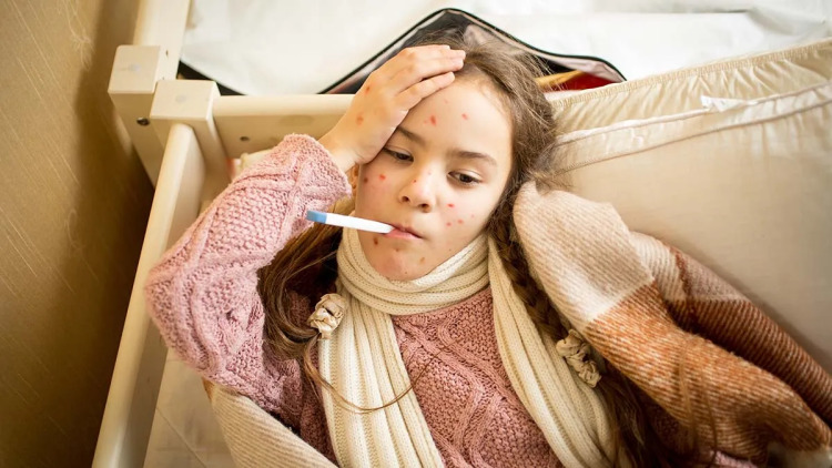 Έξαρση ιλαράς με 6.000 κρούσματα σε ένα χρόνο στην Ευρώπη – Τι συμβαίνει στην Ελλάδα