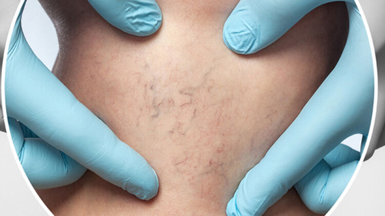 Σκληροθεραπεία: Μια αξιόπιστη λύση για την εξάλειψη των ευρυαγγειών