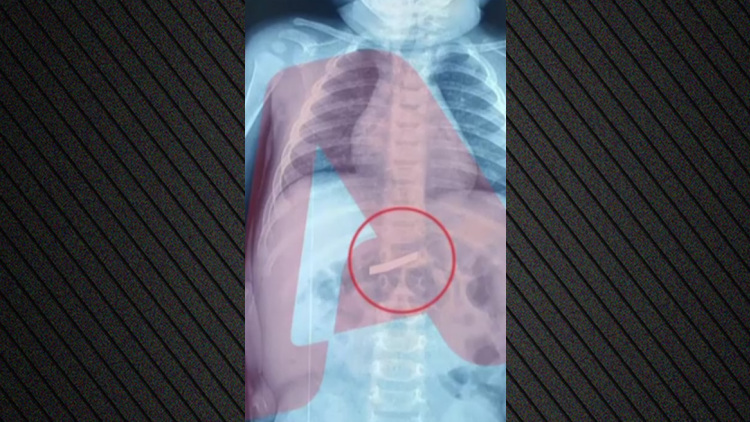 Τρίχρονος κατάπιε ξυράφι, χειρουργήθηκε στο Παίδων