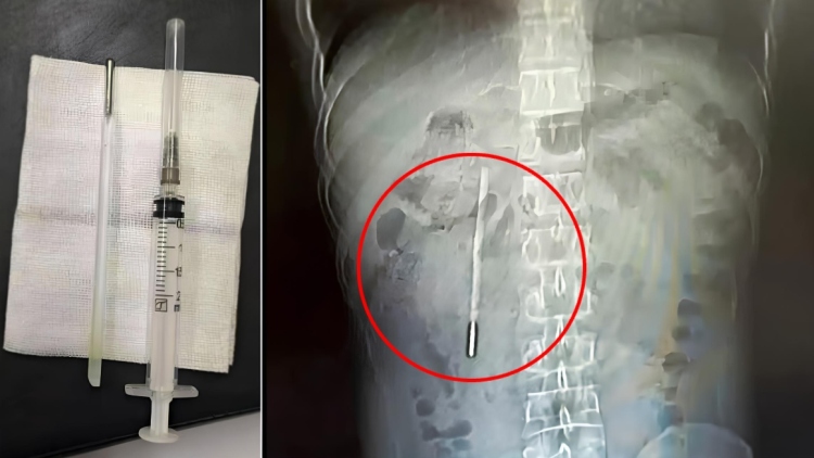 Δείτε εικόνα: Άνδρας ζούσε επί 20 χρόνια με ένα... θερμόμετρο στο σώμα του, το αφαίρεσε μετά από έντονους πόνους στο στομάχι