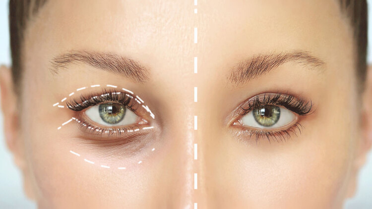 Βλεφαροπλαστική: Μια εξατομικευμένη επέμβαση που ανανεώνει το βλέμμα