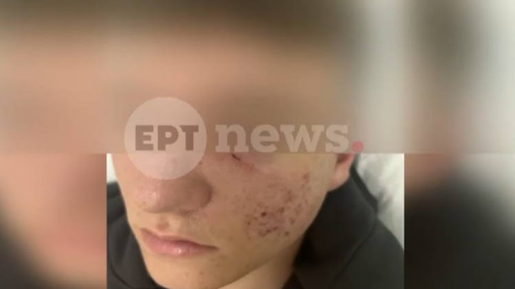 Έστησαν παγίδα και ξυλοκόπησαν 15χρονο στην Ξάνθη - «Έφαγες ξύλο αγόρι μου;» του έστειλαν μήνυμα