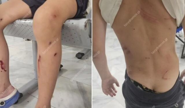 Βόλος: Από θαύμα γλίτωσε 7χρονος όταν του επιτέθηκαν αδέσποτα σκυλιά - Παραλίγο να το κατασπαράξουν, λέει η μητέρα του