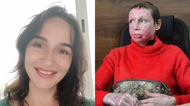 Ρωσία: 33χρονος βασάνισε 40χρονη αφού τον χώρισε - Τη «σταύρωσε» και της έβαλε φωτιά