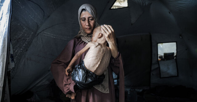 Οι New York Times διόρθωσαν την ιστορία του αποστεωμένου μικρού Μοχάμεντ από τη Γάζα: «Έχει και άλλη πάθηση»