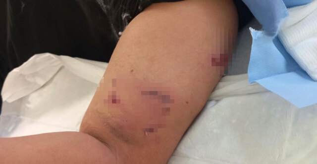 Επίθεση σκύλου σε 12χρονο έξω από σχολείο στο Πέραμα - «Ζητώ την τιμωρία του ιδιοκτήτη» λέει η μητέρα του