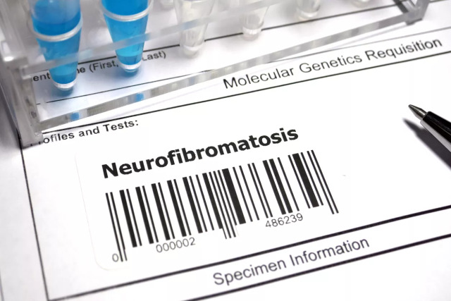 NF: Η σπάνια γενετική πάθηση που περιορίζει την αυτονομία – Καθυστερημένη διάγνωση για 1 στους 3 ενήλικες