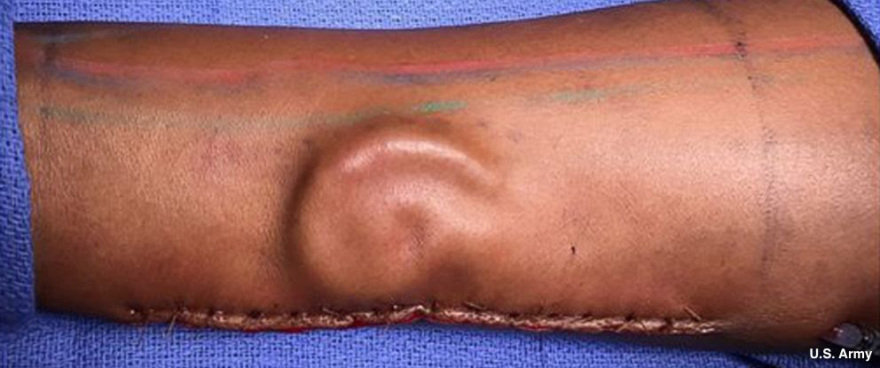 Αμερικανοί γιατροί «φύτρωσαν» αυτί σε χέρι στρατιωτικού και μετά της το μεταμόσχευσαν