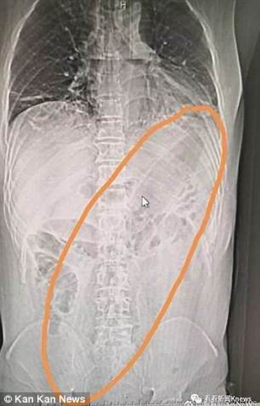 Δυσκοίλιος Κινέζος έβαλε τεράστια μελιτζάνα στον...  πρωκτό του για να... ανακουφιστεί!