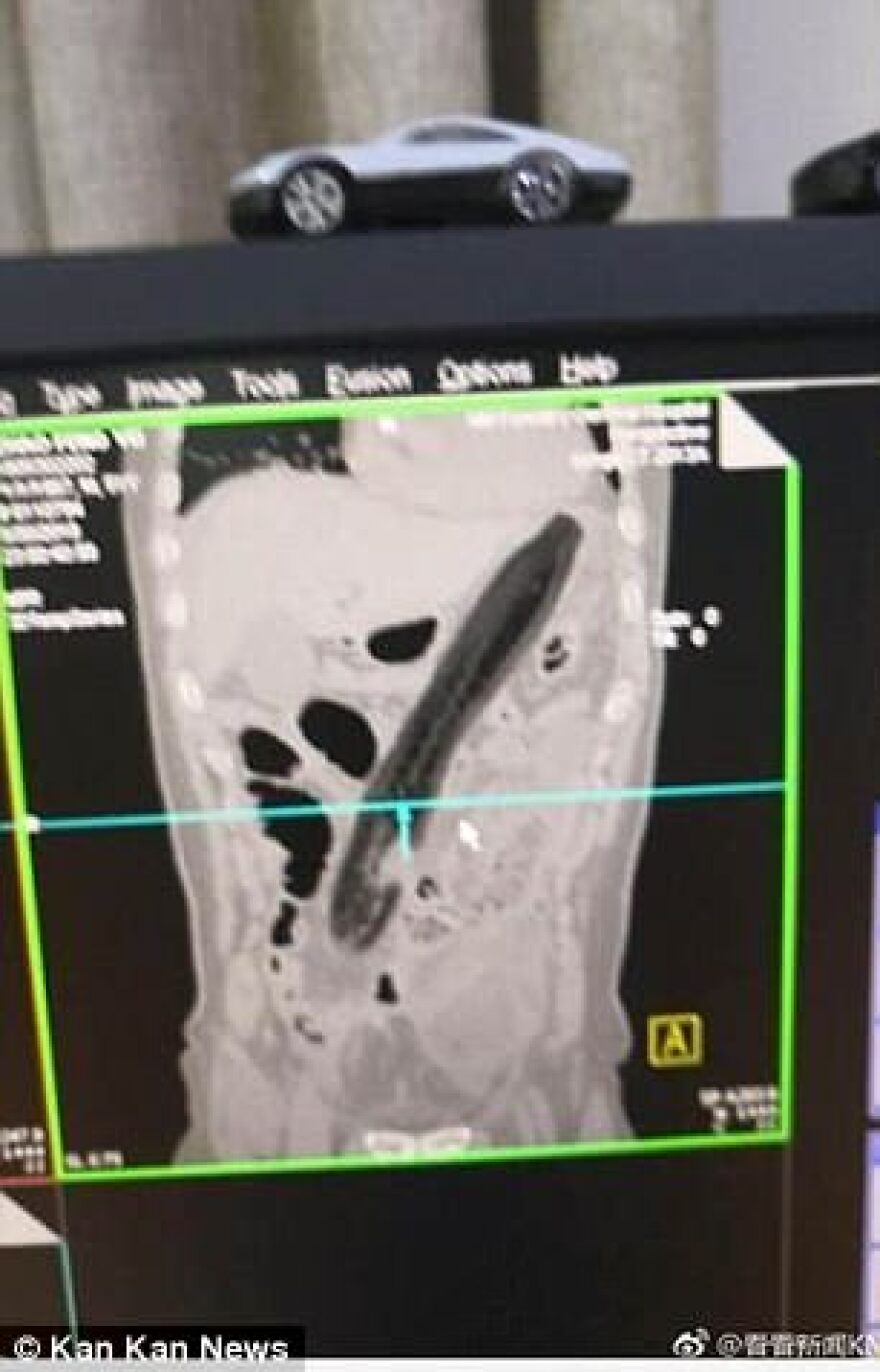 Δυσκοίλιος Κινέζος έβαλε τεράστια μελιτζάνα στον...  πρωκτό του για να... ανακουφιστεί!