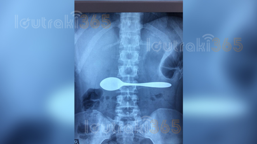 Δείτε την ακτινογραφία 35χρονης ασθενούς που άφησε... «άφωνους» τους γιατρούς του Νοσοκομείου Κορίνθου