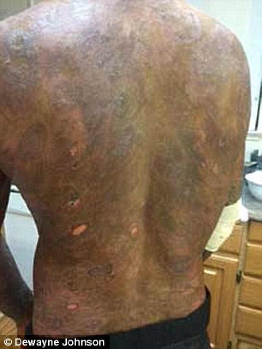 Καταδίκη για τη Monsanto: Πληρώνει αποζημίωση - μαμούθ  για εμφάνιση καρκίνου από το Roundup