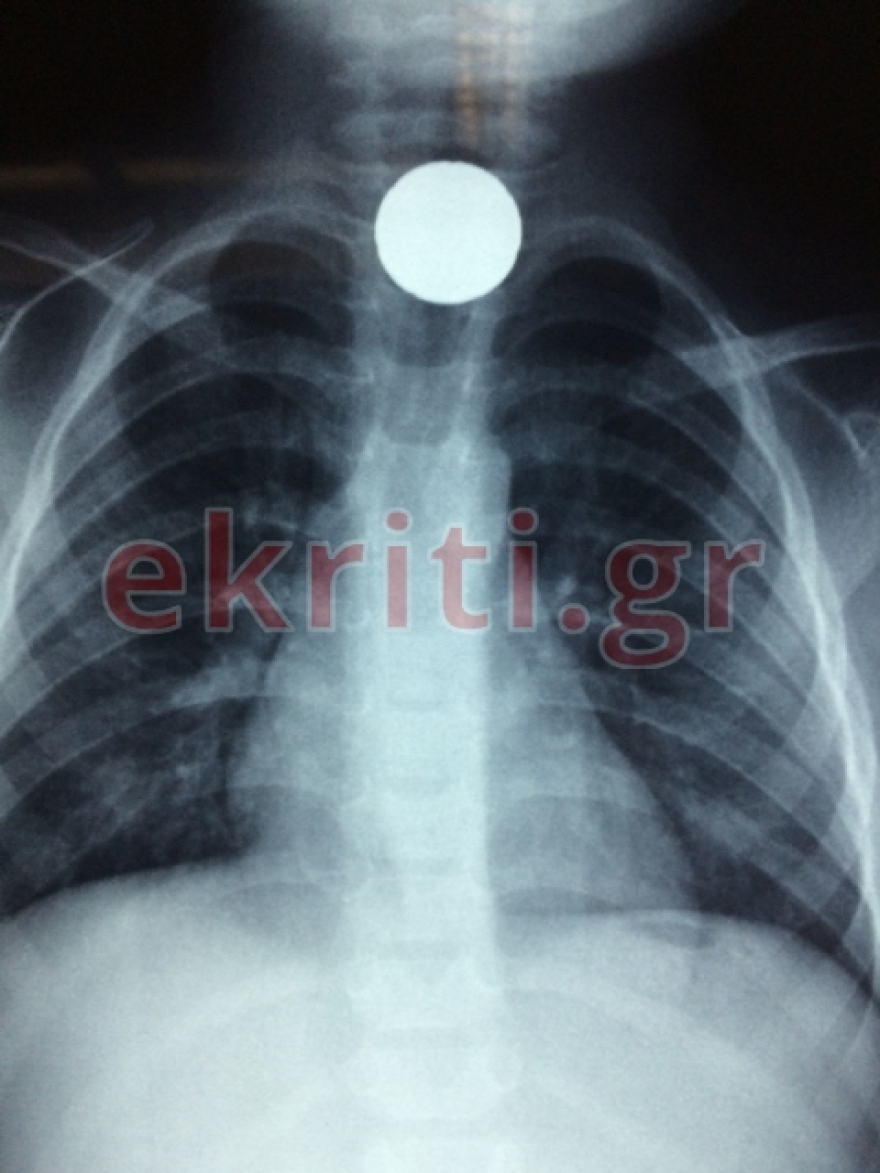 Ηράκλειο: Στο χειρουργείο αγοράκι δύο ετών που κατάπιε κέρμα