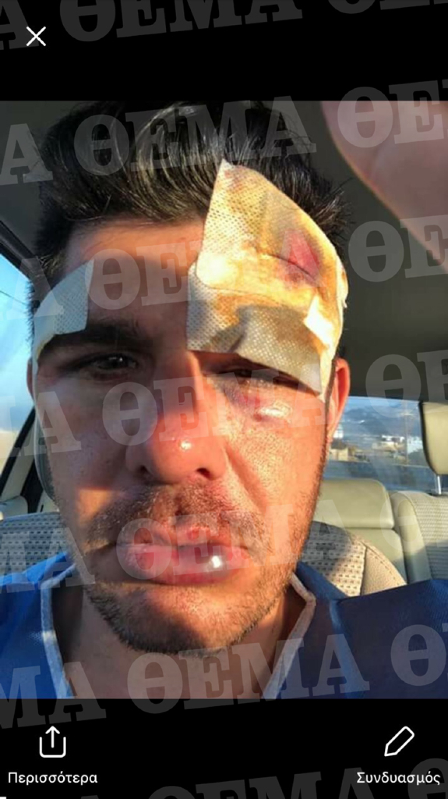 Μύκονος: Φωτογραφία σοκ από τον άγριο ξυλοδαρμό του πρώην αντιδημάρχου