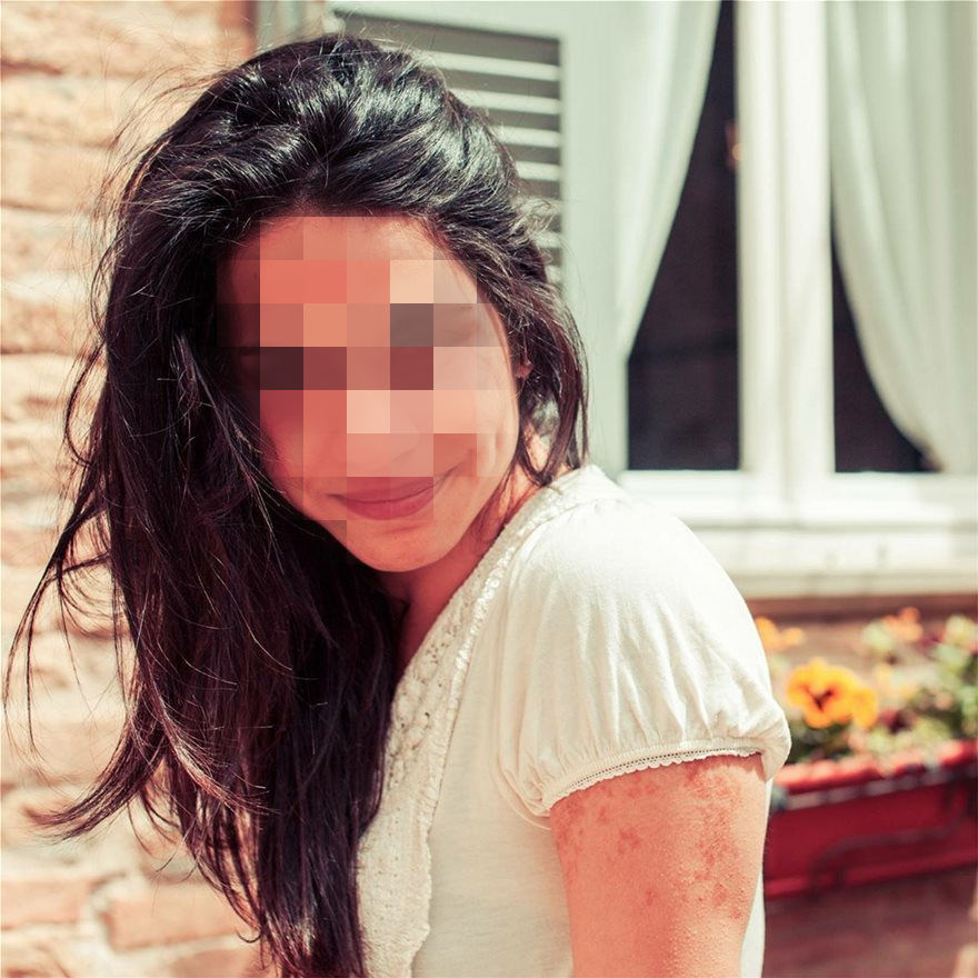 Φωτιά στο Μάτι: 51 μέρες πάλευε στην Εντατική η 26χρονη Ελισάβετ, το 99ο θύμα