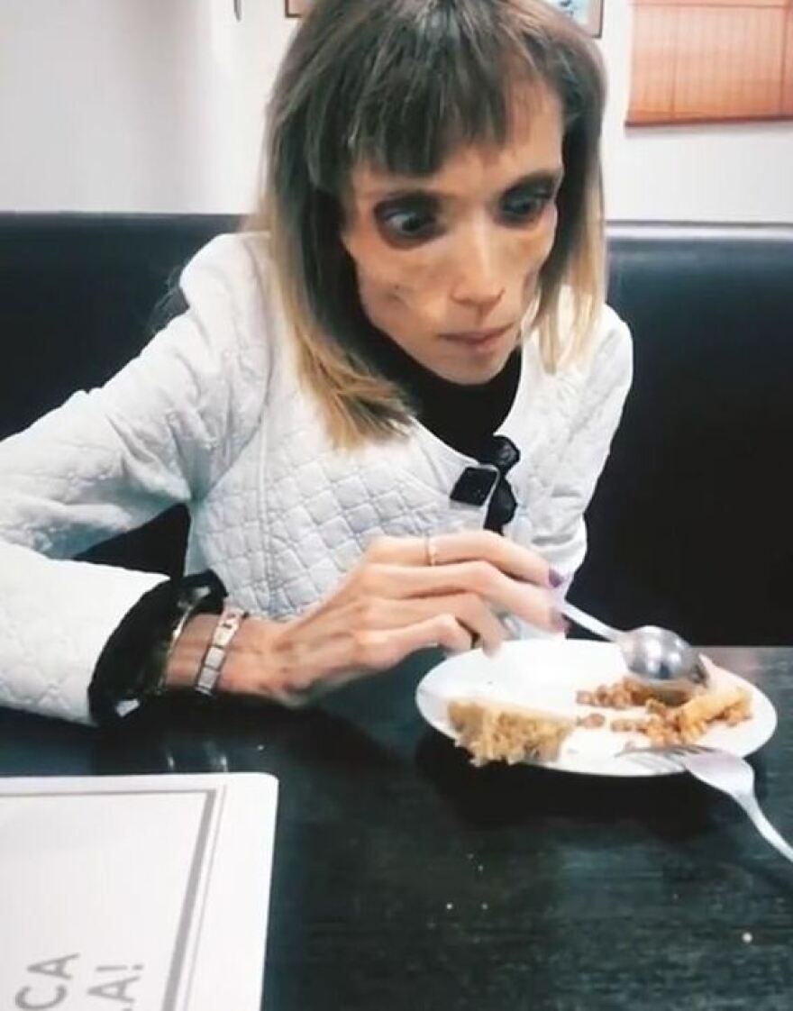 Αδιανόητη ατάκα γιατρού σε 26χρονη ανορεξική: Μπορείς να παίξεις το ζόμπι σε ταινία τρόμου