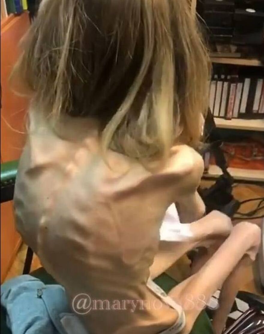 Αδιανόητη ατάκα γιατρού σε 26χρονη ανορεξική: Μπορείς να παίξεις το ζόμπι σε ταινία τρόμου