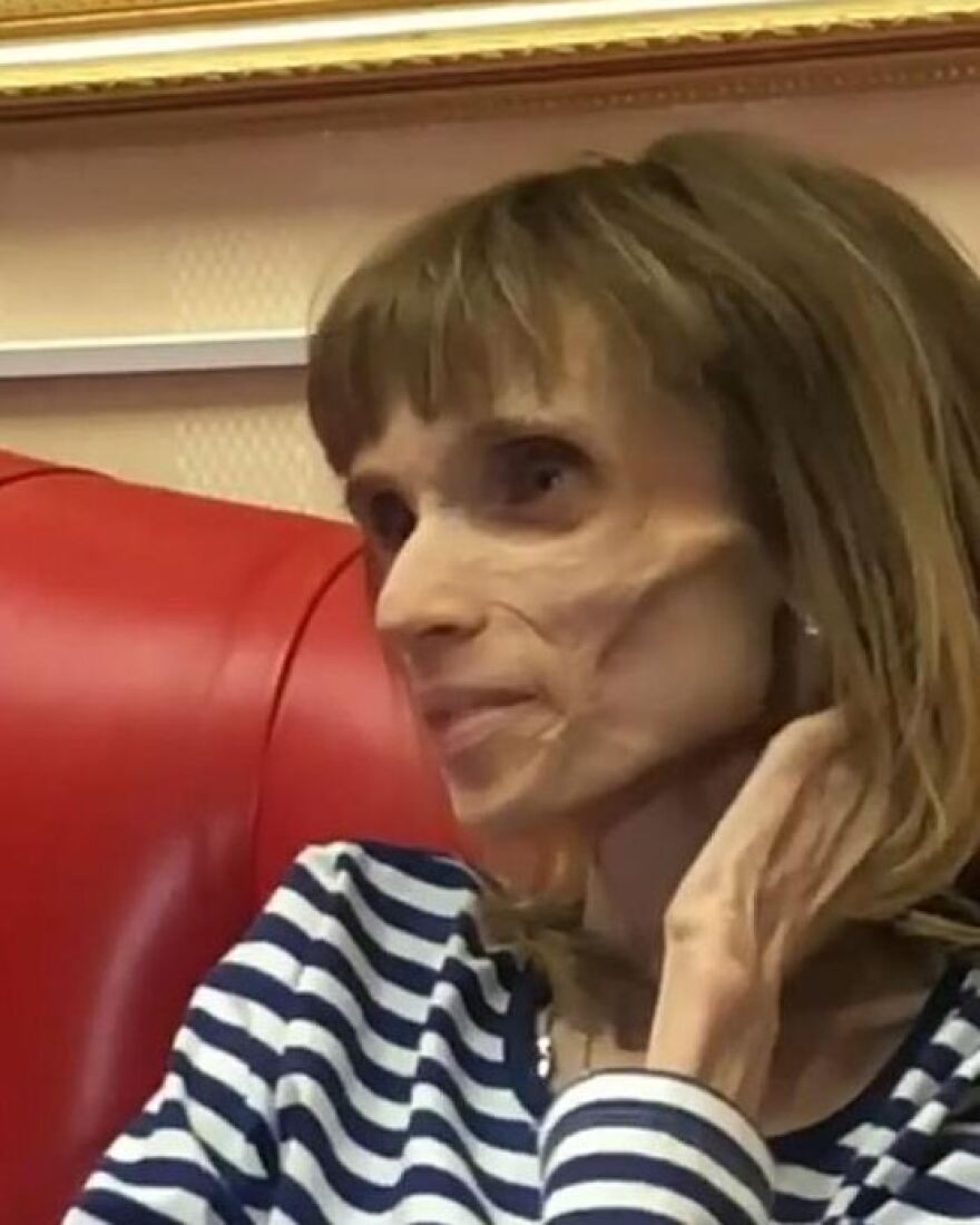 Αδιανόητη ατάκα γιατρού σε 26χρονη ανορεξική: Μπορείς να παίξεις το ζόμπι σε ταινία τρόμου