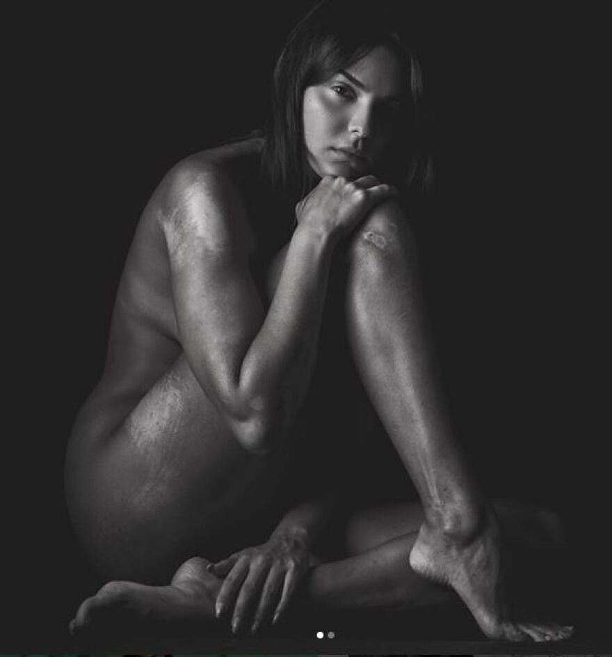 Πρώην παίχτρια του My Style Rocks φωτογραφήθηκε γυμνή με τα τραύματα από το τροχαίο ατύχημά της