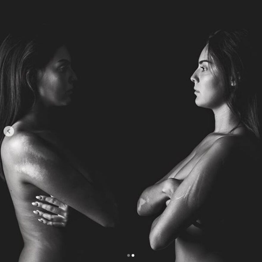 Πρώην παίχτρια του My Style Rocks φωτογραφήθηκε γυμνή με τα τραύματα από το τροχαίο ατύχημά της