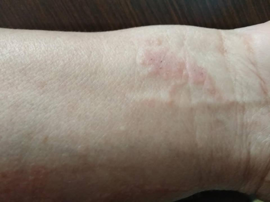  Στον ακήρυχτο πόλεμο της Λευκίμμης - Έχασε το χέρι του σε επεισόδια με την Αστυνομία 