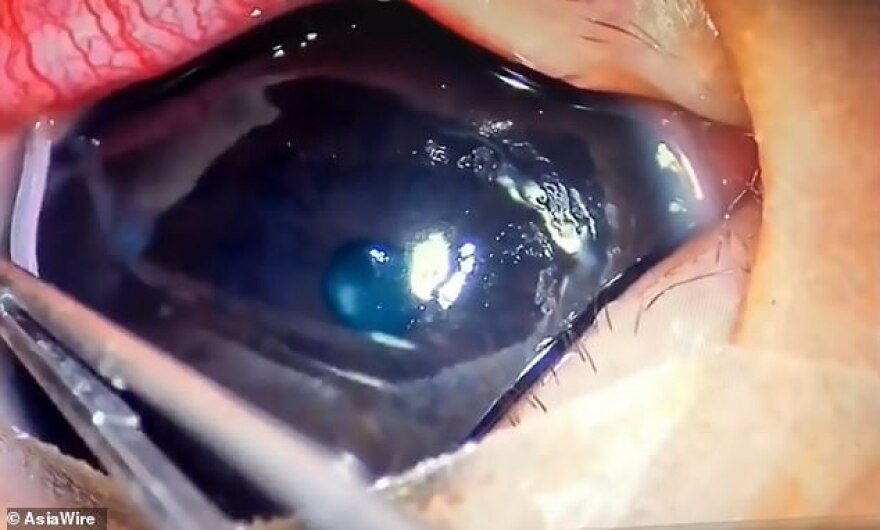 Κίνα: Γιατροί έβγαλαν 11 σκουλήκια από το μάτι βρέφους 