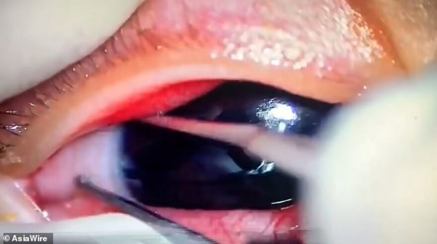 Κίνα: Γιατροί έβγαλαν 11 σκουλήκια από το μάτι βρέφους 