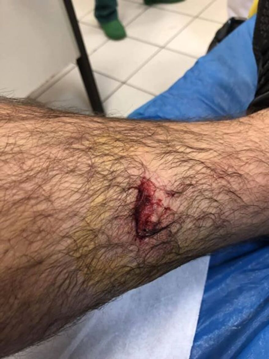 Πάτρα: Σκύλος επιτέθηκε σε νεαρό και τον δάγκωσε στο πόδι