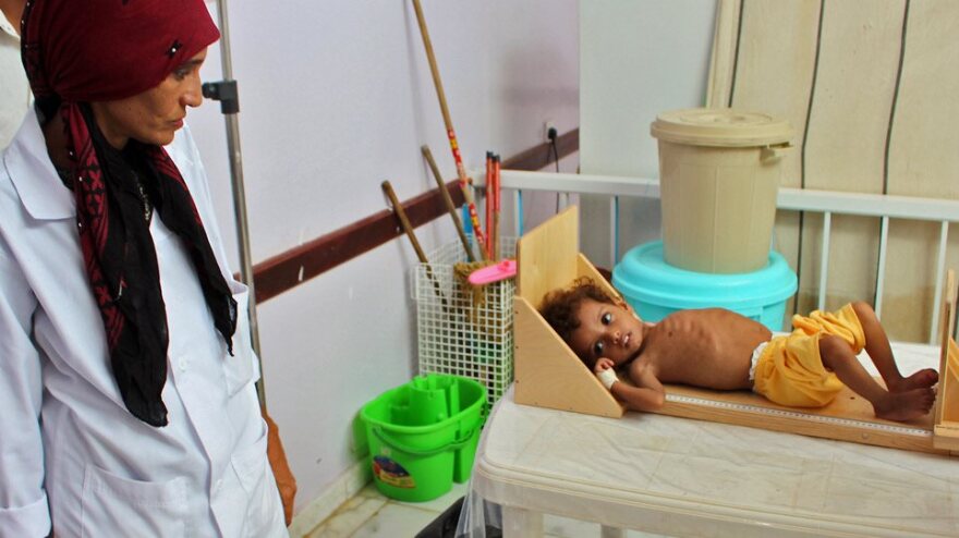 Υεμένη: Συγκλονίζουν οι φωτογραφίες αποστεωμένων παιδιών στα νοσοκομεία