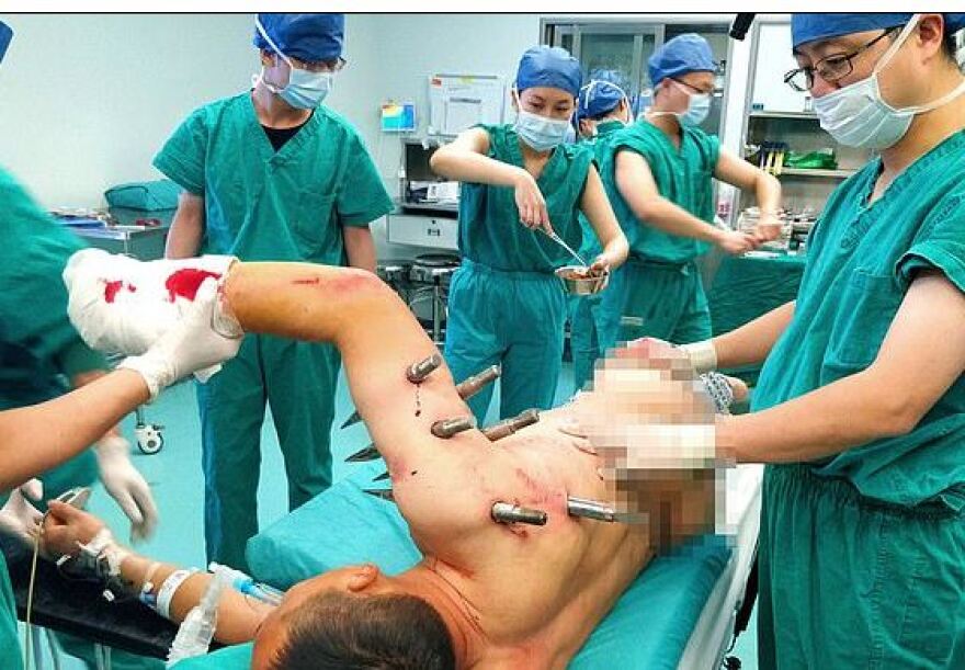 Εργοστασιακό ρομπότ «τρελάθηκε» και «κάρφωσε» εργάτη με δέκα πελώριους ατσάλινους πασσάλους