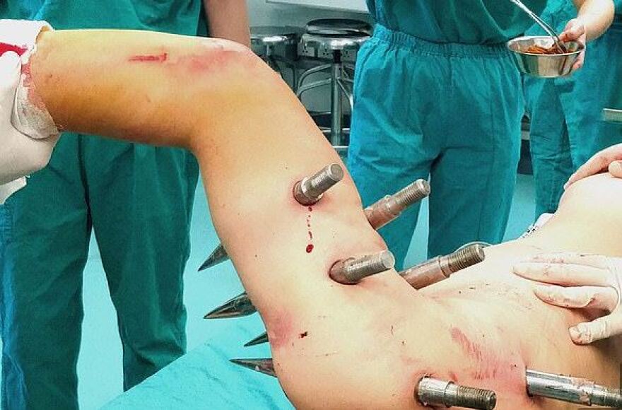 Εργοστασιακό ρομπότ «τρελάθηκε» και «κάρφωσε» εργάτη με δέκα πελώριους ατσάλινους πασσάλους