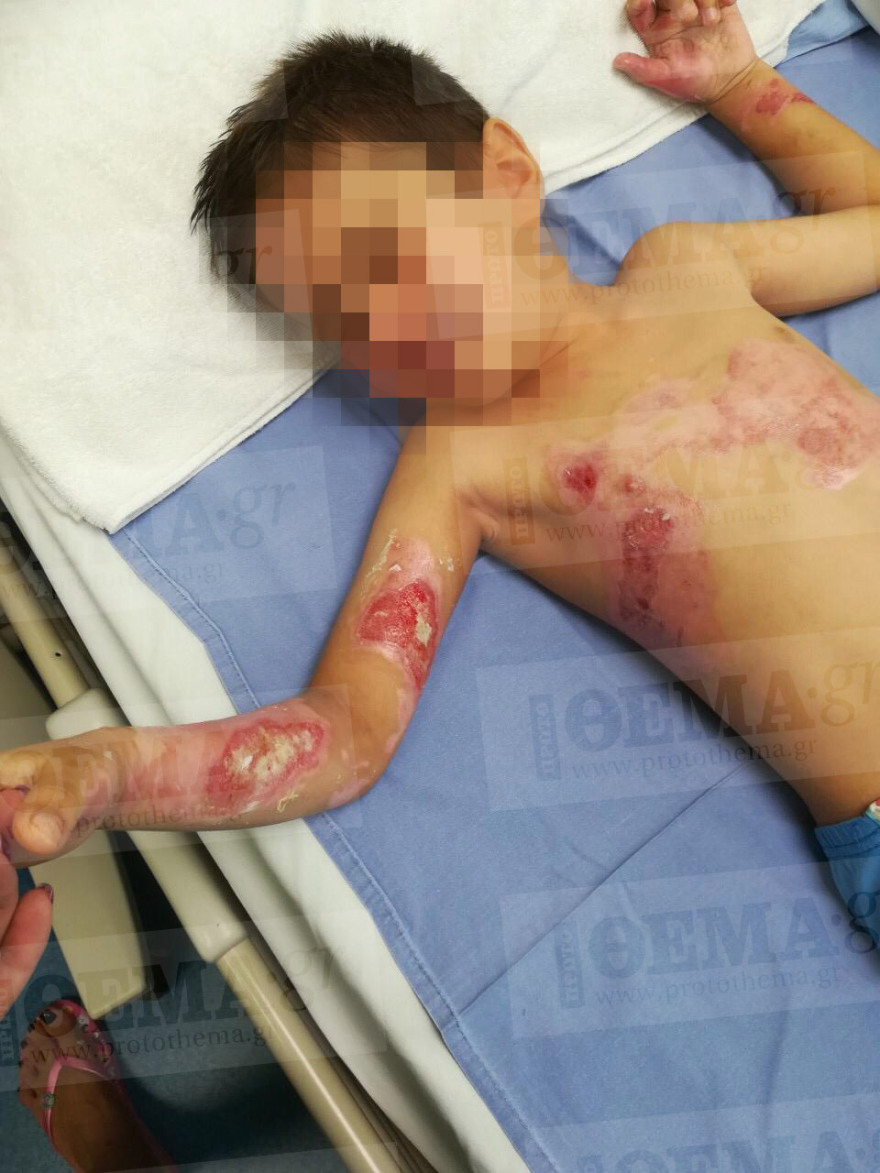 Σοκ: 5χρονος υπέστη σοβαρά εγκαύματα όταν έπεσε πάνω του καυτό νερό μέσα σε εστιατόριο