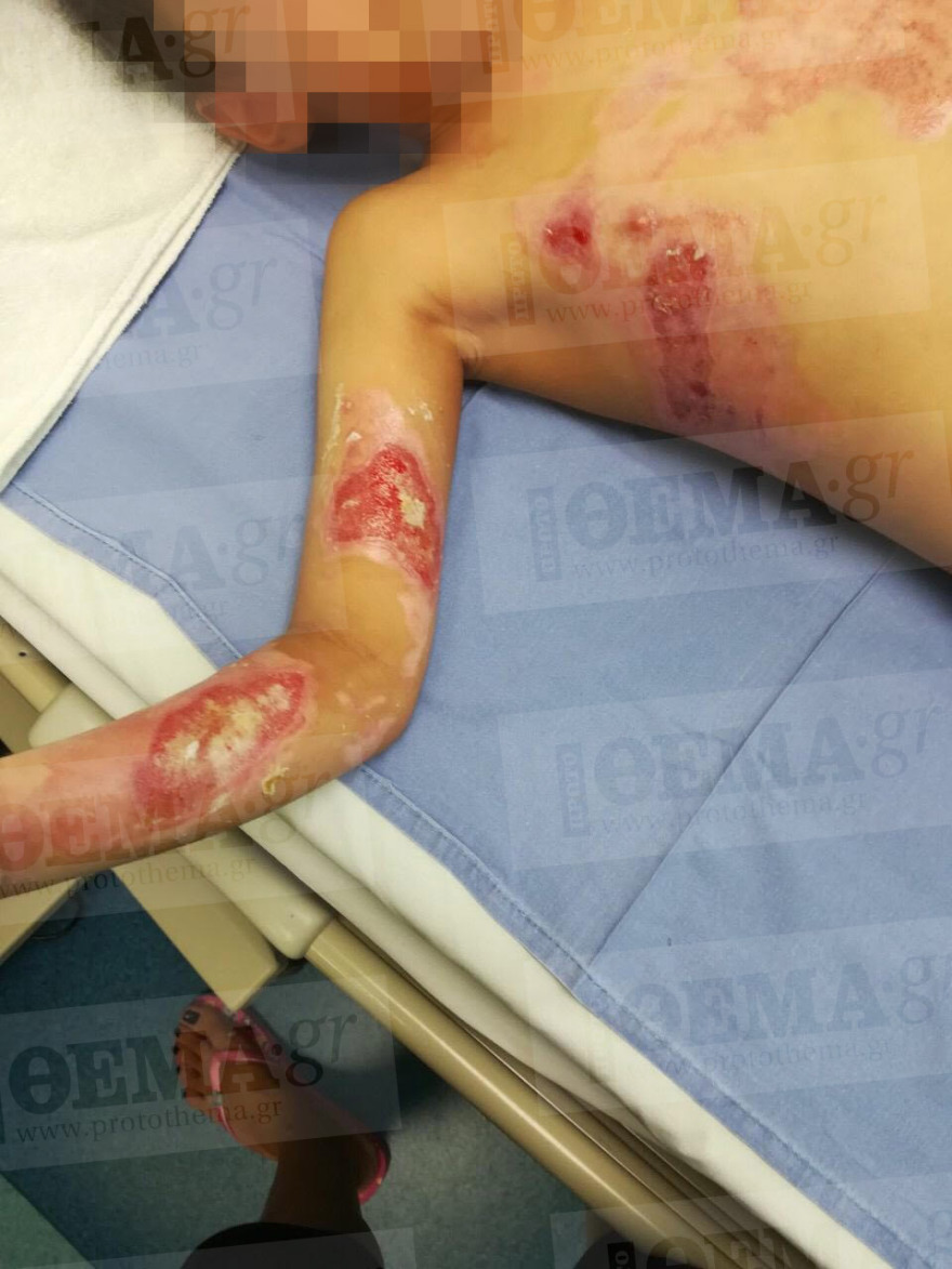 Σοκ: 5χρονος υπέστη σοβαρά εγκαύματα όταν έπεσε πάνω του καυτό νερό μέσα σε εστιατόριο