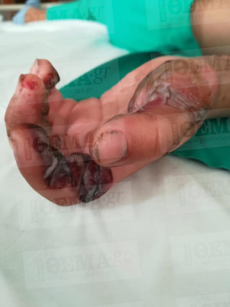 Σοκ: 5χρονος υπέστη σοβαρά εγκαύματα όταν έπεσε πάνω του καυτό νερό μέσα σε εστιατόριο