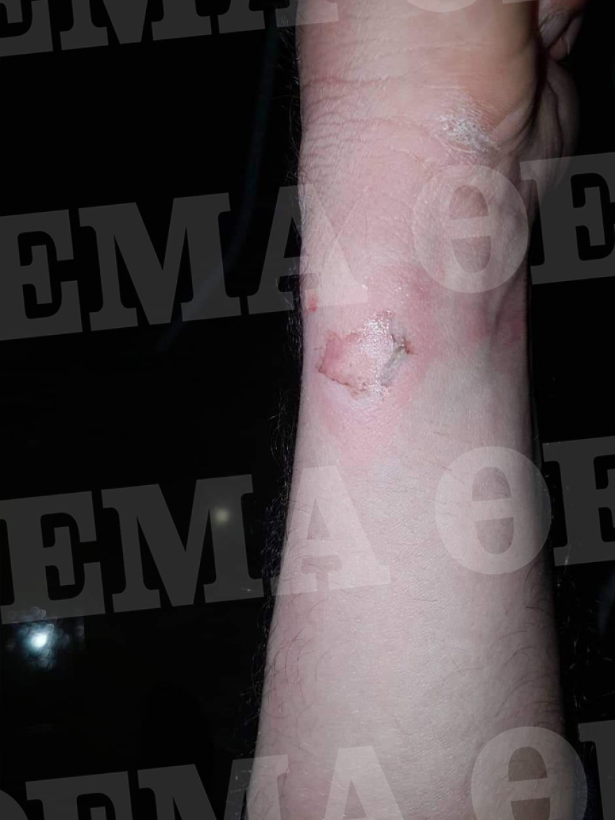 Φωτογραφίες: Τα τραύματα των αστυνομικών που μεταφέρθηκαν στο 401