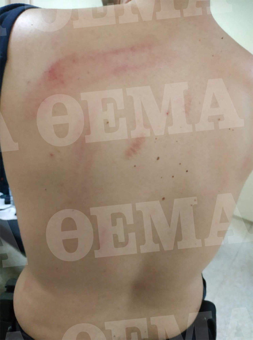 Φωτογραφίες: Τα τραύματα των αστυνομικών που μεταφέρθηκαν στο 401