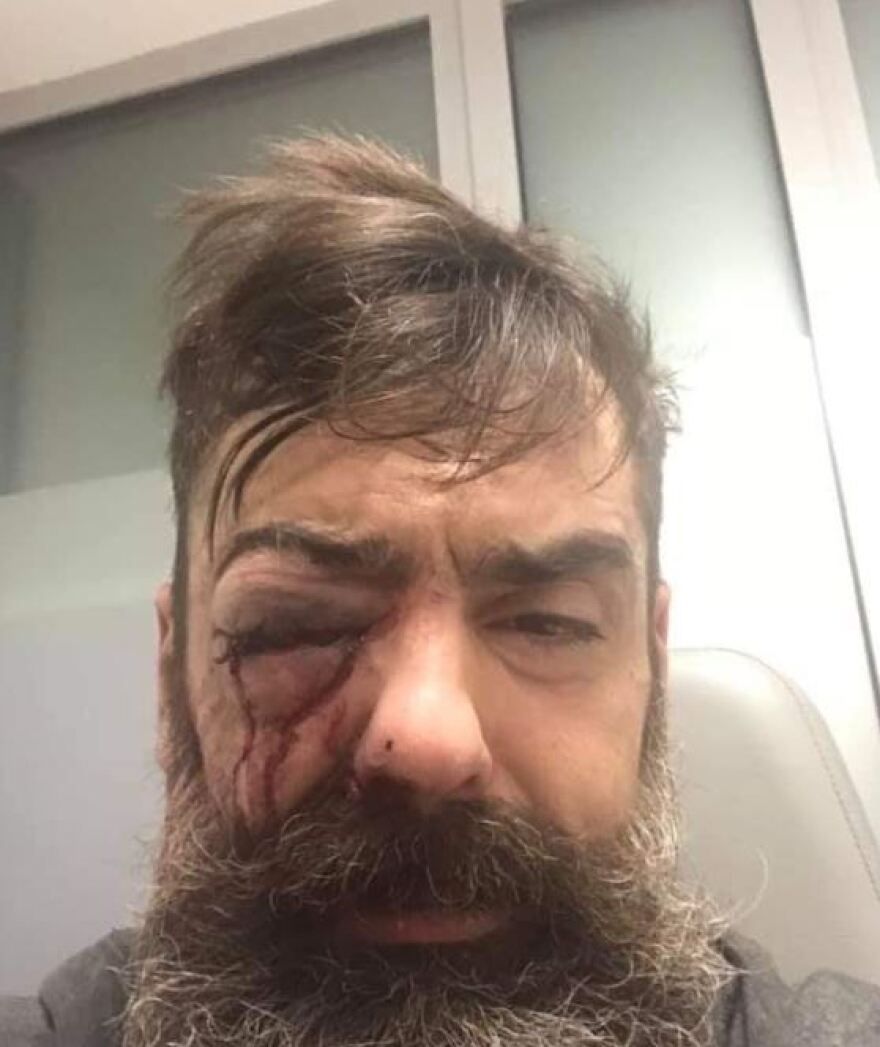 Ηγετική μορφή των Κίτρινων Γιλέκων τραυματίστηκε σοβαρά στο μάτι κατά τη χθεσινή διαδήλωση