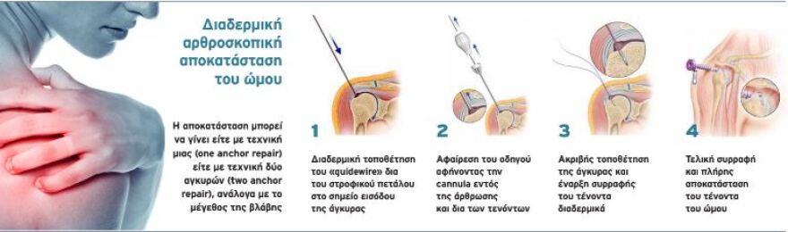 «Τέλος» στον πόνο λόγω ρήξης τενόντων του ώµου