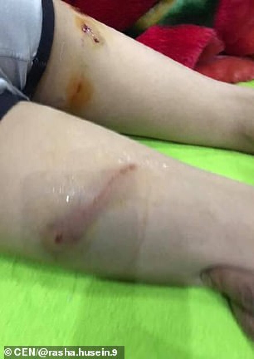 Γυναίκα έσωσε με αυτοθυσία μικρό αγόρι που δέχθηκε άγρια επίθεση από σκυλιά