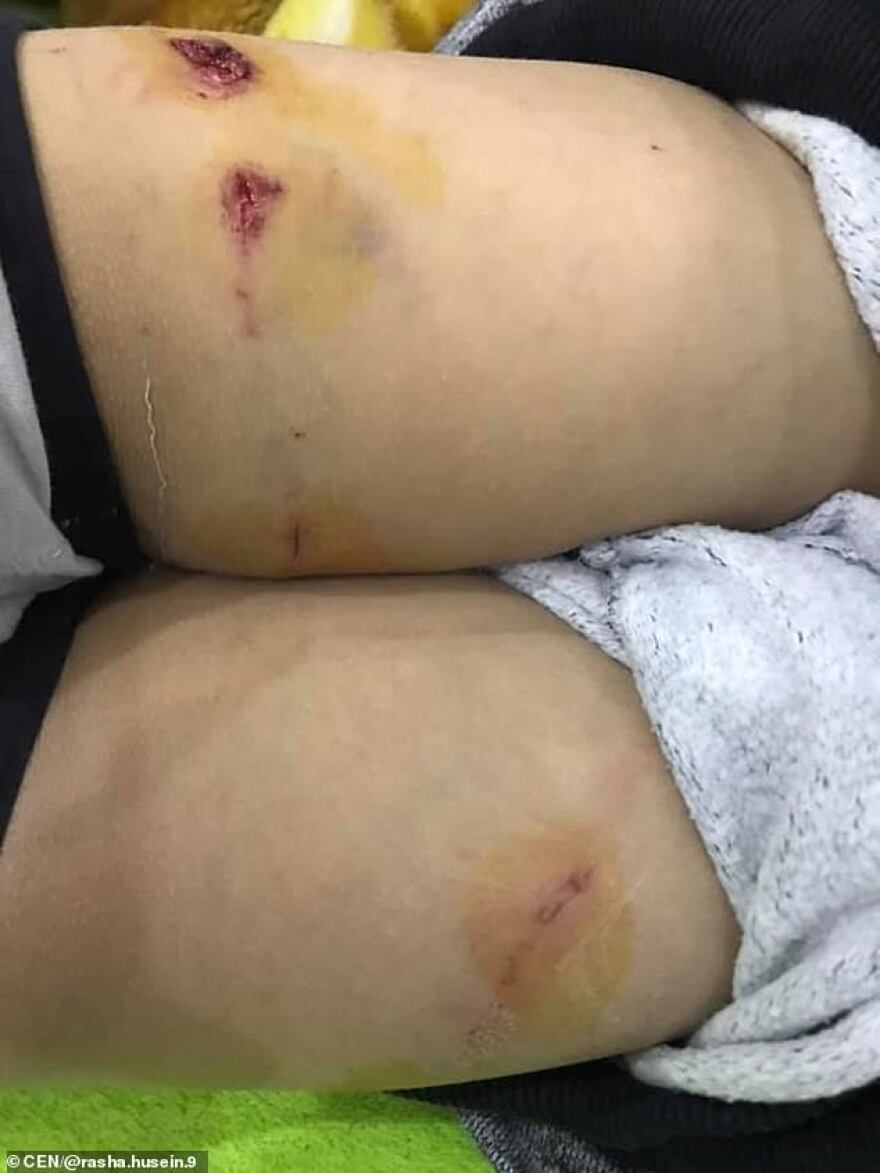 Γυναίκα έσωσε με αυτοθυσία μικρό αγόρι που δέχθηκε άγρια επίθεση από σκυλιά