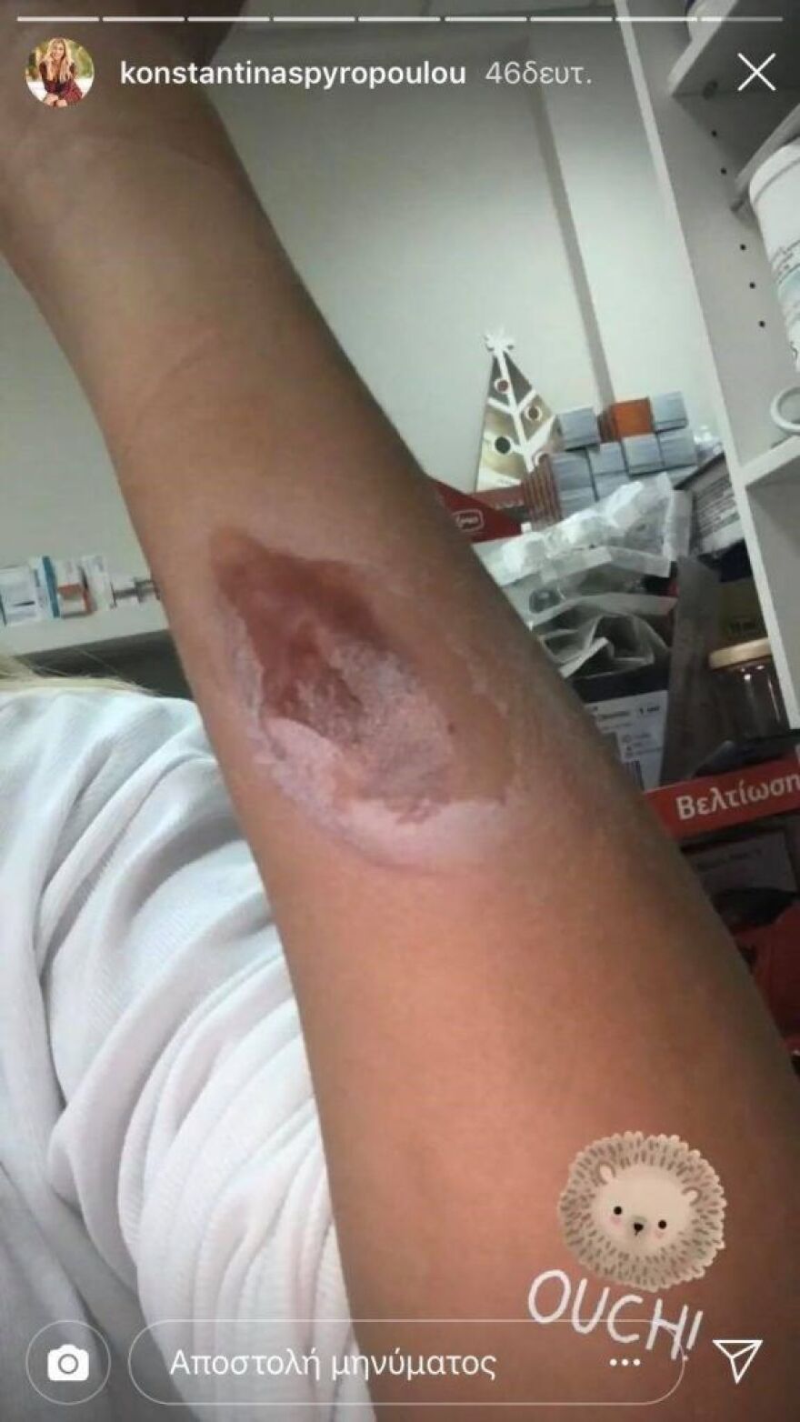 Η Κωνσταντίνα Σπυροπούλου κάηκε στο χέρι και το ανέβασε στο Instagram