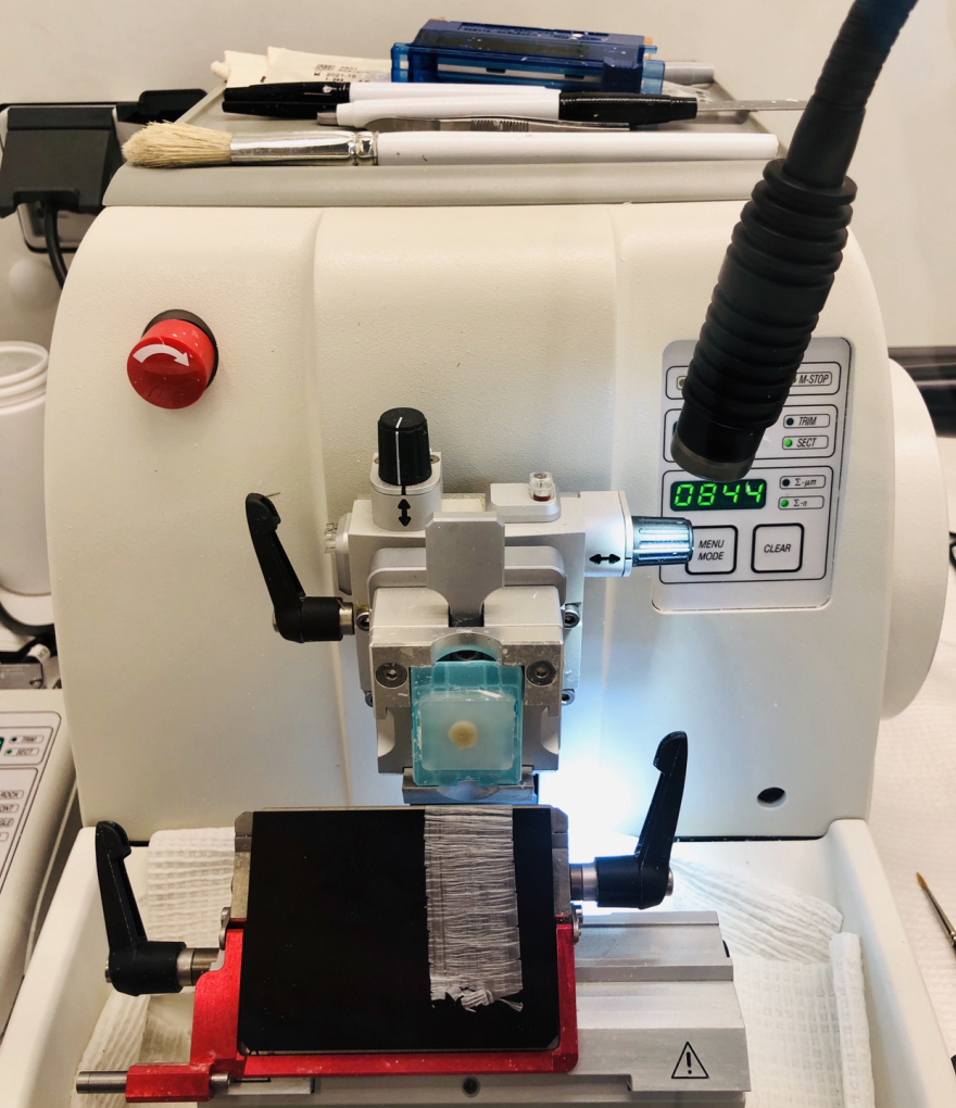 Ενθαρρυντικές για την αντιμετώπιση ανθεκτικών καρκίνων οι νεότερες θεραπείες με ραδιενεργά ισότοπα